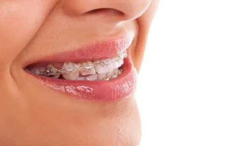 Teeth with braces Stock Photos