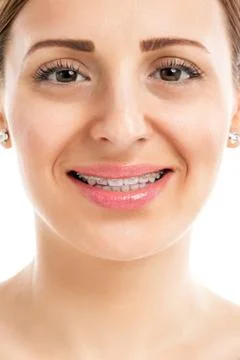 Teeth with braces Stock Photos