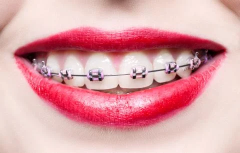 Teeth with braces Stock Photos