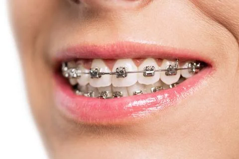 Teeth with braces Stock Photos
