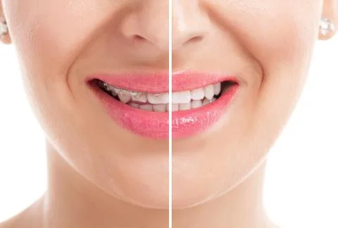Teeth with braces Stock Photos