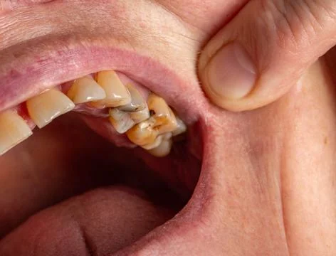 Teeth with caries and pulpous teeth in the mouth of a female patient. Dental Foto stock