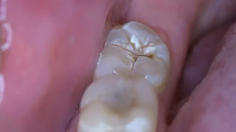 Teeth with caries in the mouth of a man, close-up Stock Footage 86001604