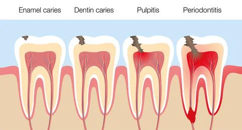 Teeth Caries Stages Pulpitis Periodontitis Enamel Caries Stock Illustration