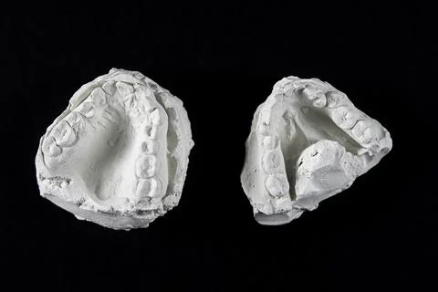 Teeth cast mold of the jaw made of plaster for orthodonist work Stock Illustration
