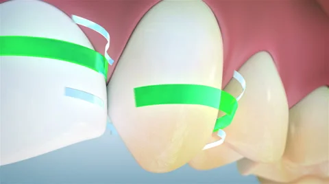 Teeth cleaning 库存影片 38492076