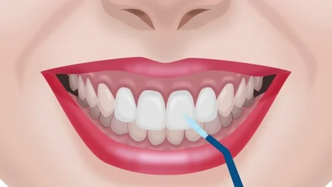 Teeth cleaning with an irrigator Stock Footage 151020655