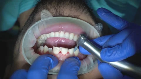Teeth Cleaning Procedure Stock Footage 316913768