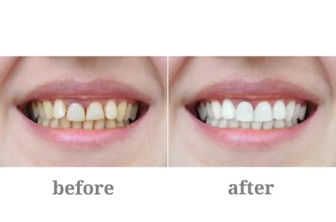 Teeth close-up after dental therapy and whitening. Before and after. Stock Photos