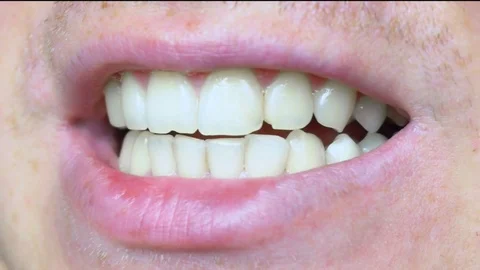 Teeth close-up, chipped teeth Stock Footage 81812541