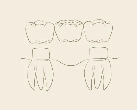 Teeth with crown bridge beige color Stock Illustration
