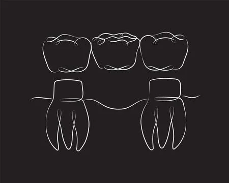 Teeth with crown bridge black color Stock Illustration