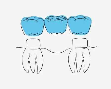 Teeth with crown bridge white and blue Stock Illustration