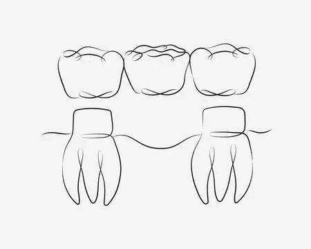 Teeth with crown bridge white color Stock Illustration