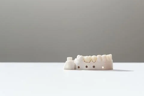 Teeth Crowns And Bridge Equipment Model Shows Fix Restoration, Prosthodontics Or Foto stock
