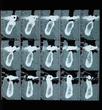 Teeth CT xray Stock Photos