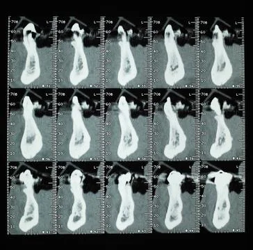 Teeth CT xray 스톡 사진