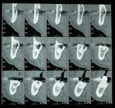 Teeth CT xray 스톡 사진