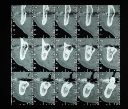Teeth CT xray Stock Photos