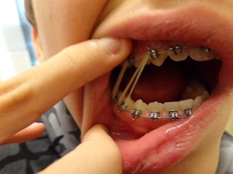 Teeth device with draft 13/44, 14/45 Stock Photos