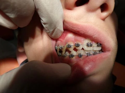 Teeth device with elastic pull 13/44, 14/45 Photos