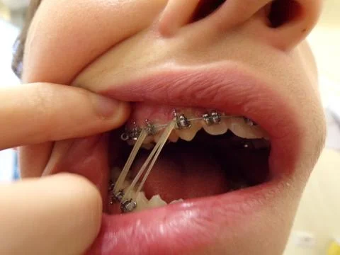 Teeth device with elastic pull 13/44, 14/45 Stock Photos