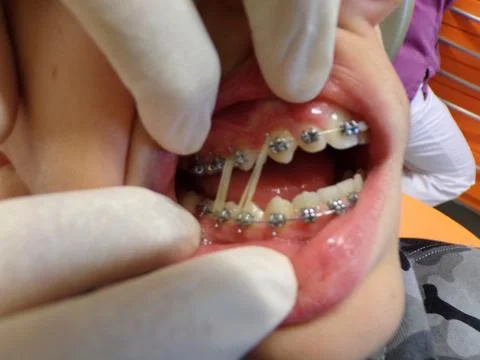 Teeth device with elastic pull Stock Photos