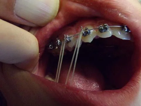 Teeth device with elastic pull Stock Photos