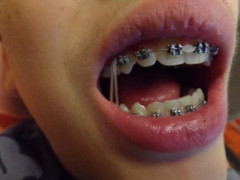 Teeth device with elastic pull Stock Photos