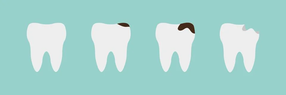 Teeth on different stages of caries. Tooth decay, toothache. Stock Illustration