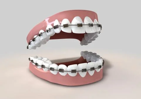 Teeth fitted with braces Stock Illustration