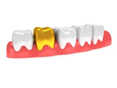 Teeth on gingiva isolated on white back. 스톡 일러스트