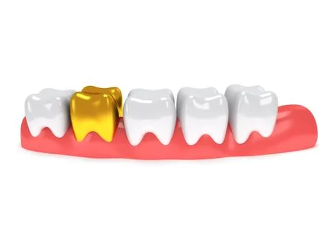 Teeth on gingiva isolated on white back. 스톡 일러스트