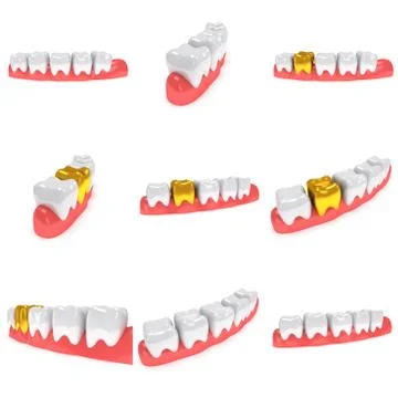 Teeth on gingiva isolated on white back. 스톡 일러스트