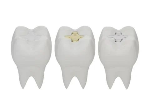Teeth with gold, amalgam and composite inlay dental filling Stock Illustration
