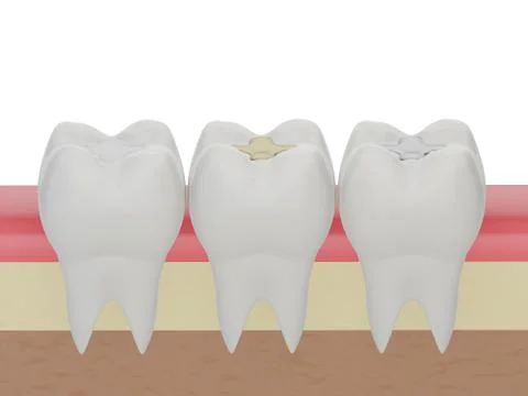 Teeth with gold, amalgam and composite inlay dental filling 스톡 일러스트
