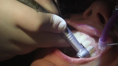 Teeth grinding mockup Stock Footage 61156363