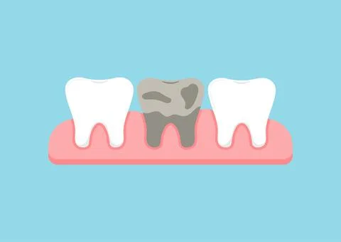 Teeth in gum with dead decay tooth dentistry sign isolated on blue background. Stock Illustration