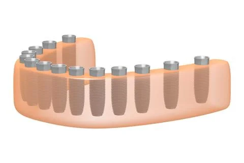 Teeth implants/ dental implants Stock Illustration