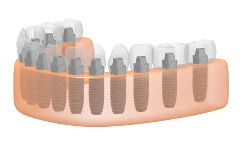 Teeth implants/ dental implants Stock Illustration