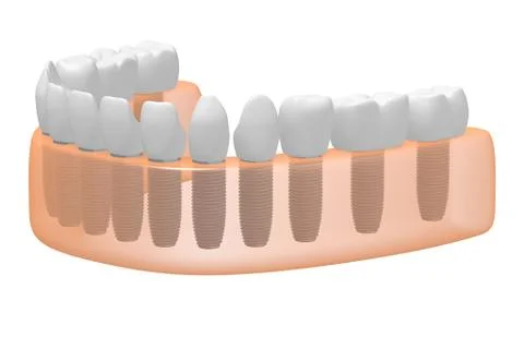 Teeth implants/ dental implants Illustrazione stock