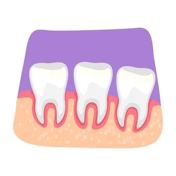 Teeth inflammation 2D vector isolated illustration Stock Illustration