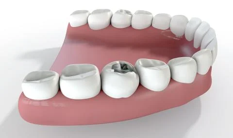 Teeth With Lead Filling Stock Illustration