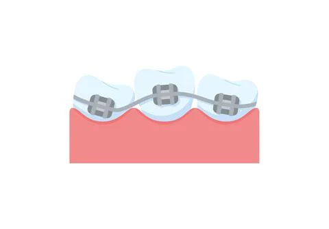 Teeth with metal braces for correction flat style, vector illustration Stock Illustration
