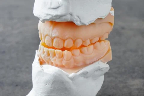 Teeth mold of an underbite malocclusion used for jaw surgery. Foto stock