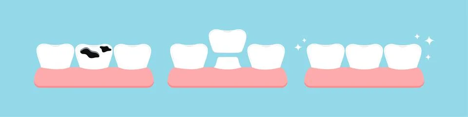 Teeth multiple caries, crown stage in gym before and after dental icon set Stockillustratie