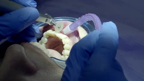 Teeth polishing at the dentist Stock Footage 149262461