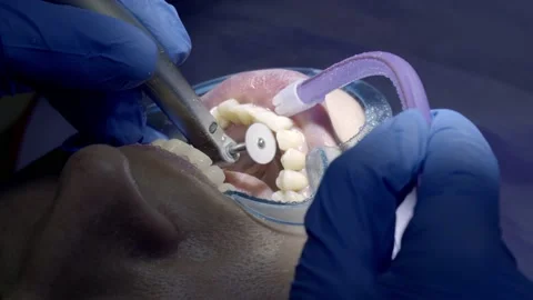 Teeth polishing at the dentist Stock Footage 149262478