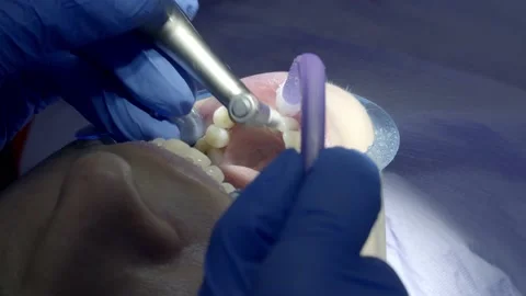 Teeth polishing at the dentist Stock Footage 149262538