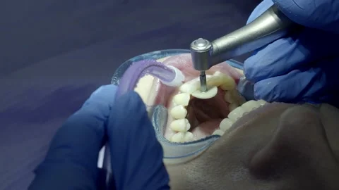 Teeth polishing at the dentist Stock Footage 149262541